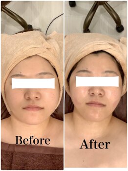 スペチアーレ 夙川/鳴り止まない人気の小顔ハイリフ