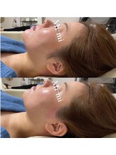 ミーミドットアイ(Mi-mi.i)/艶肌フェイシャルワックス脱毛