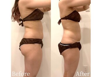 ミスティア(mistia)/エステ 全身3回