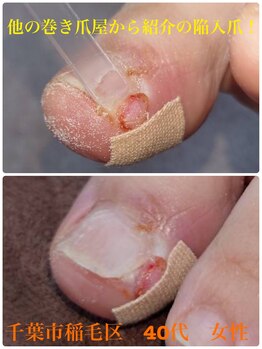 巻き爪じゅん 千葉駅前店/どんな爪の痛みもお任せ下さい！