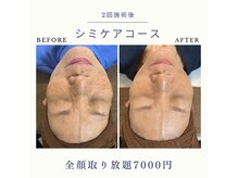 ＊シミケアし放題＊