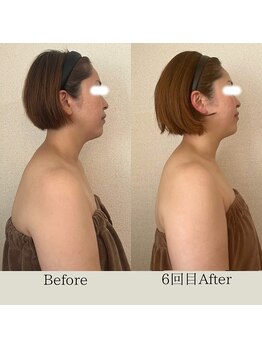 リーブル(LIBRE)/小顔コルギ 6回