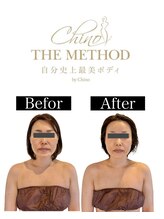 アンベリール(Embellir)/ほうれい線もきれいに☆