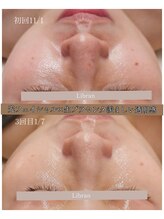 リブラン(Libran)/皮膚薄め赤み肌改善♪