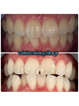 ホワイトニングショップ 三田店/before after