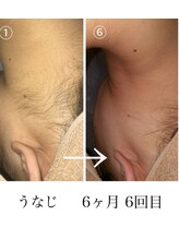 サロンエヌ 久留米店(Salon N)/うなじ脱毛before/after