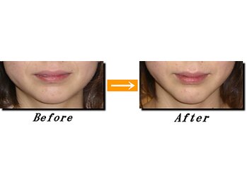 ナチュライズ(NatuRise)の写真/顔が V になる美容鍼。小顔になりたい、たるみ、むくみが気になる方◎