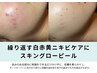 【先着残り8名様限定】約50%OFF/      肌育美容法スキングローピール￥4,950-