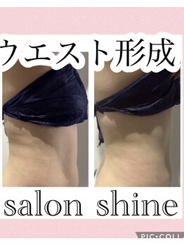 サロンシャイン(Salon Shine)/痩身エステ４０代