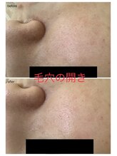 エスティ 梅田店/毛穴の開きbefore/after