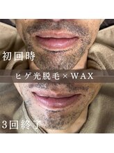 エピナ 横浜店(Epina)/髭MIX脱毛☆