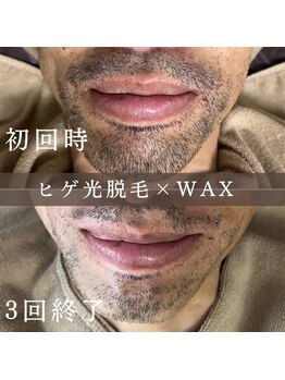 エピナ 横浜店(Epina)/髭MIX脱毛☆