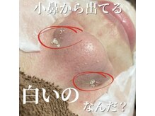 ミラーヴ(MERAVE)/角栓にょきにょき！