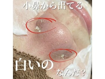 ミラーヴ(MERAVE)/角栓にょきにょき！