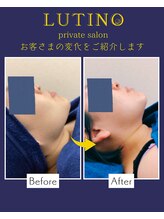 ルチノ(LUTINO)/脂肪分解30代施術回数1回