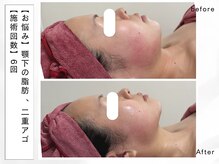 レッド(RED)/お痛みが苦手な方にもおすすめ