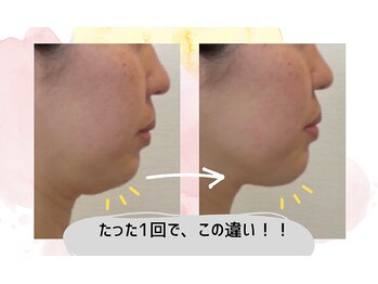 ビューティ エアー ユキ(Beauty air Yuki)の写真/二重アゴに効果大◎韓国発・脂肪分解サポート『レモンボトル』で夏前に理想のフェイスラインを手に入れる！