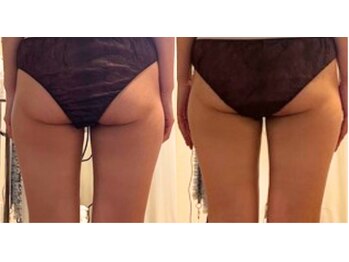 サロンドエムジョリー 横浜(Salon de M jolie)/お尻アップと脂肪燃焼に超絶効果