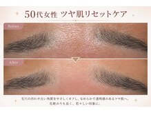 フラワー(FLOWER)/50代女性　ツヤ肌リセット 1回目