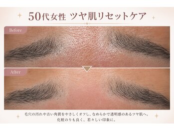 フラワー(FLOWER)/50代女性　ツヤ肌リセット 1回目