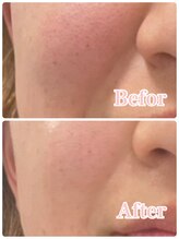 アドア(ADORE)/Eライトフェイシャル