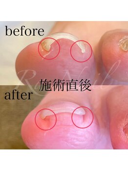 ラネイル(Ra Nail)/【巻き爪/陥入爪】親指1本