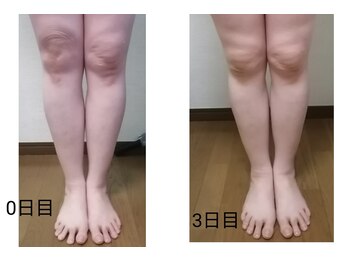 ギイ 巣鴨店(Gie)/３日目て体の引きつり軽減してる