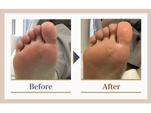 巻き爪補正店 錦糸町店/【タコ・魚の目ケア】