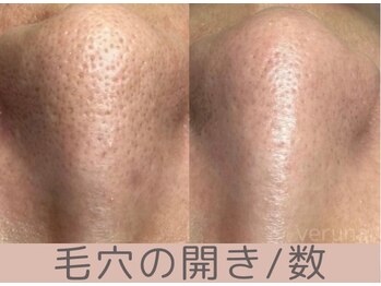 ベアール(beal)/毛穴特化ハーブピーリング3ヶ月