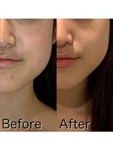 ラノン(LANON)/ビフォーアフター20