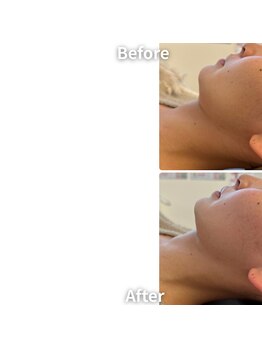 エムボーテ 太田店(M BEAUTE33)/顔筋小顔コルギ