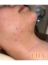 ベルフィオーレ(bel fiore)/20代女性　ララピール　After