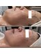 ピエルポゼ(Piereposer)の写真/脂肪分解美容液リポベラで夏までにすっきりフェイスラインへ！