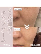 テセラ(Tethere)/ヒト幹細胞×エクソソーム