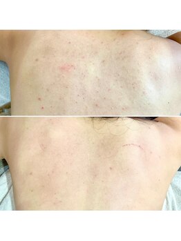 エレナ(ERENA)/背中ハーブピーリング