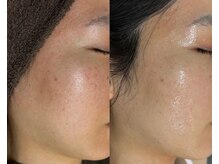 シェリートーキョー 成田店(Cherie Tokyo)/セルマン/韓国式肌管理/成田店