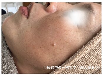 白の雫/肌印象の変化（施術経過の一例）