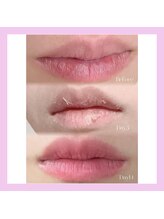 キワミビューティ(KIWAMI BEAUTY)/ローマピンク　唇　症例