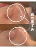 9年不動人気No.1【毛穴黒ずみ/開きに】クリーンケア(鼻)+毛穴洗浄全顔&首