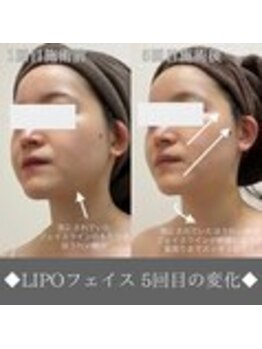 ナンバーファイブクリニカルサロン 札幌店(No.5)の写真/都度払いOK！リフトアップ引き上がる小顔ケアで、理想の自分に出会う時間を☆