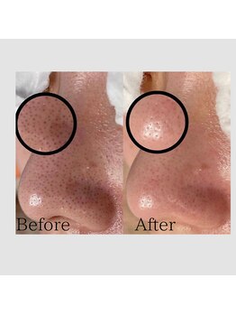 毛穴専科/脱!いちご鼻!韓国式毛穴洗浄