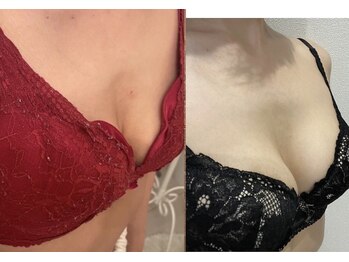 メゾン アンジュ(Maison Ange)/バストアップ症例/B→Eカップ