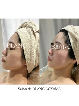 サロン ド ブラン アオヤマ(Salon de BLANC AOYAMA)/ビオフィート×ソノケア