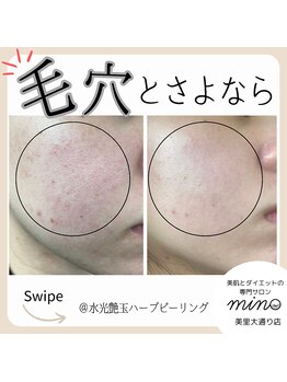 ミノ 美里大通り店(mino)/ハーブピーリングの力♪