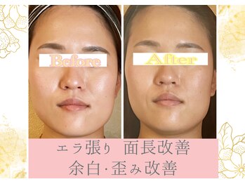 ラトビア(Latvia)/顎関節の動き・痛み・雑音改善