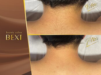 ベクスト(BEXT)/うなじ・背中脱毛(PRO)