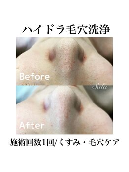 サラ/ハイドラ毛穴洗浄