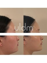 シルク(Silk)/ULDM管理