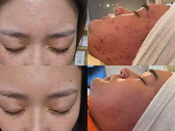 エスポワール(ESPOIR)の写真/憧れ水光肌へ◎ケアナキレイ×HARiハーブピーリングのWアプローチ！スピキュールで弾むようなハリを実感♪