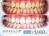 【都度払い★リピーター様専用】業界No.1ホワイトニング1回(8分×２)￥5000